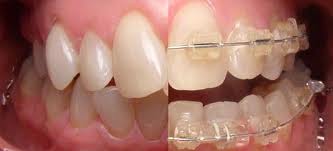 Ortodonzia estetica