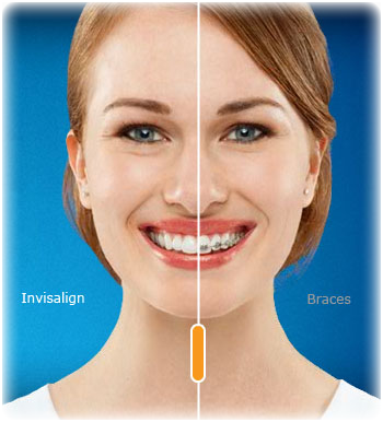 Esempio Invisalign