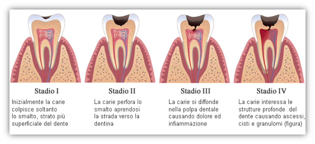 Carie dentali