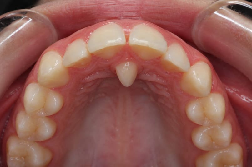 denti sovrannumerari o in più
